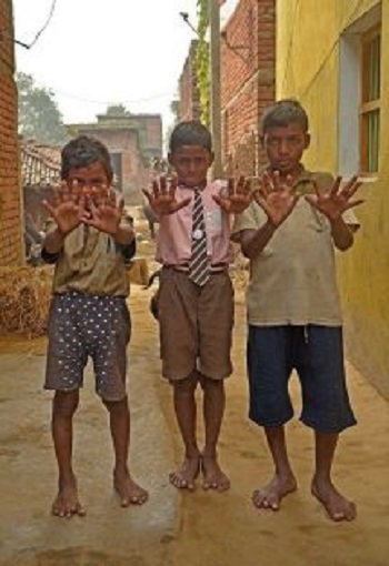 جهش ژنتیکی ۱۰۰ انگشت به خانوادۀ هندی اضافه کرد!+تصاویر