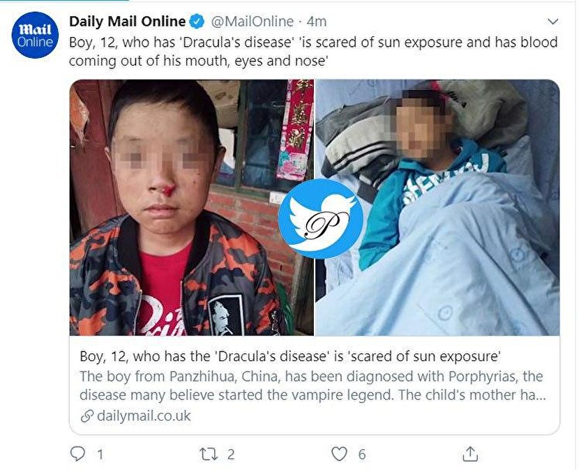 یک اتفاق نادر؛ پسربچه ۱۲ ساله چینی دراکولا شد؟! +عکس