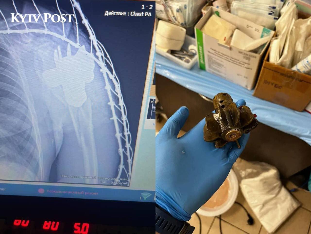 این مین بزرگ از بدن سرباز اوکراینی خارج شد!+ عکس